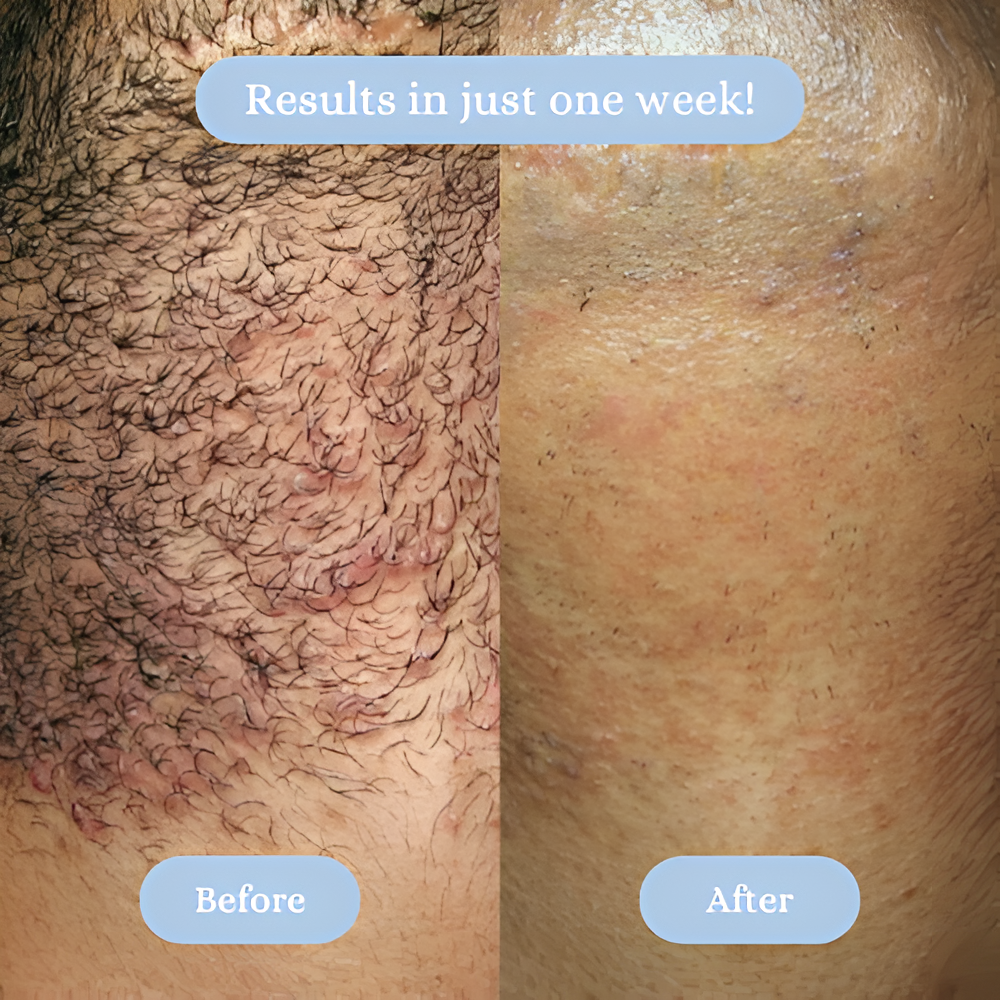Illurea™ Ingrown Serum